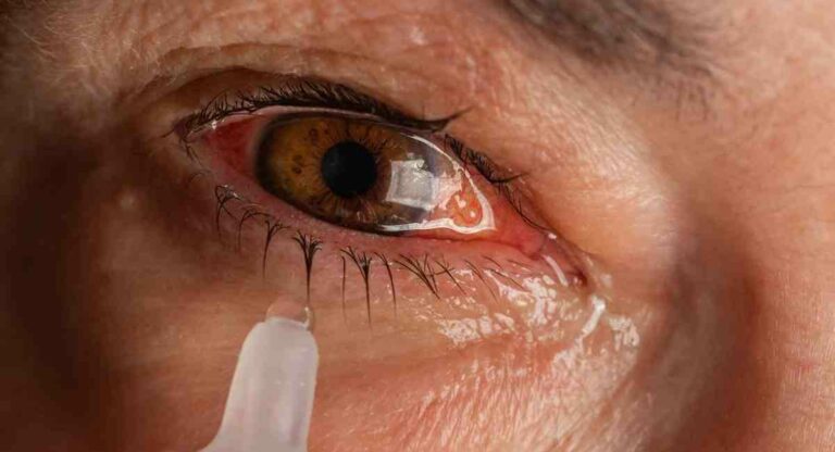 Eye Flu : पावसाळ्यात होणार्‍या आय फ्ल्यूपासून ’असा’ करा स्वतःचा बचाव