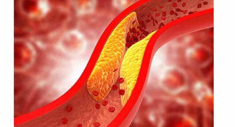 Colestrol : ‘या’ तेलात जेवण बनवलं तर टळेल हाय कोलेस्ट्रॉलचा धोका