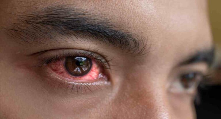 Eye Flu : डोळे आल्यावर करा ‘हे’ ४ उपाय