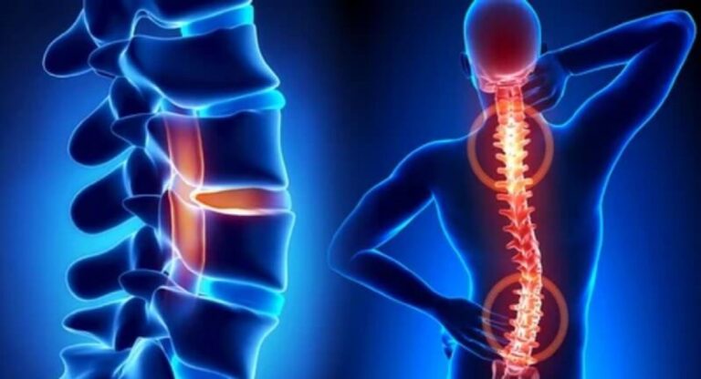 Spinal Disorders : पालिकेच्या ‘या’ रुग्णालयात मणक्याच्या विकारांवर मोफत शस्त्रक्रिया