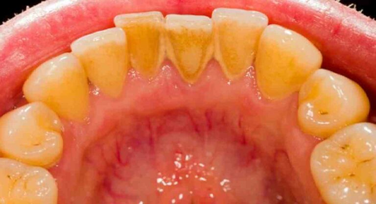 Teeth : दातांवरचा काळापिवळा थर होईल चुटकीसरशी नष्ट, ‘या’ 5 उपायांनी हटवा टार्टर