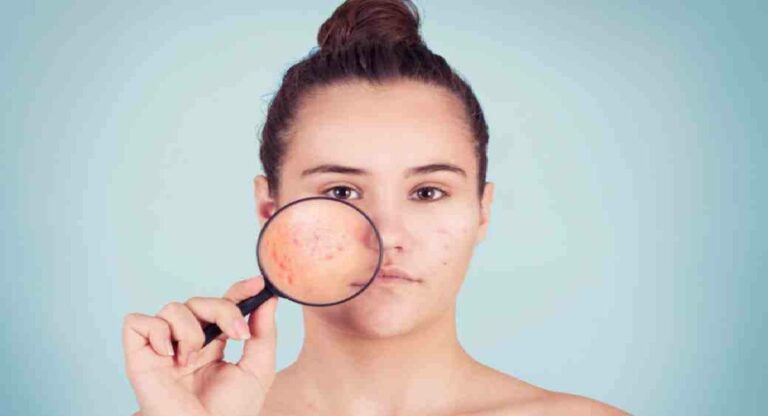 Beauty Tips : महागडे उपाय करून सुद्धा, पिंपल्स जात नाही ? करा हे घरगुती उपाय